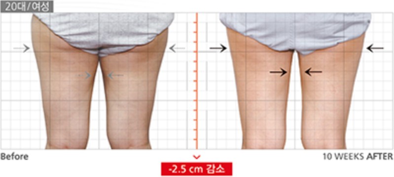 전후사진